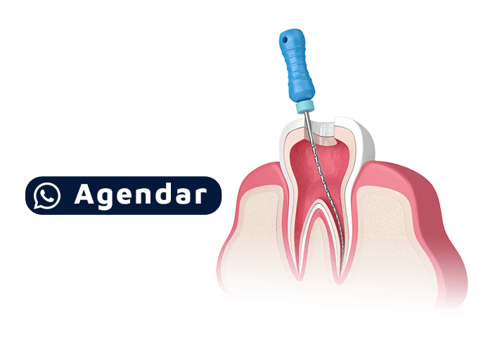 promoción endodoncia en clinica brelo concepción