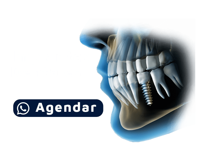 promoción de implantes dentales en concepción