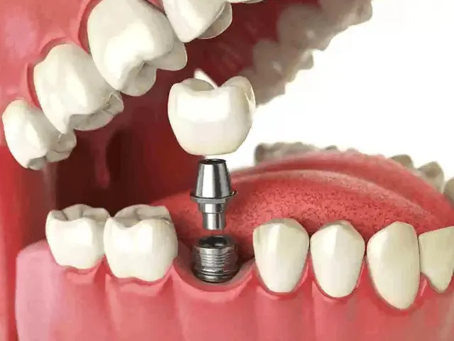 Prótesis dental