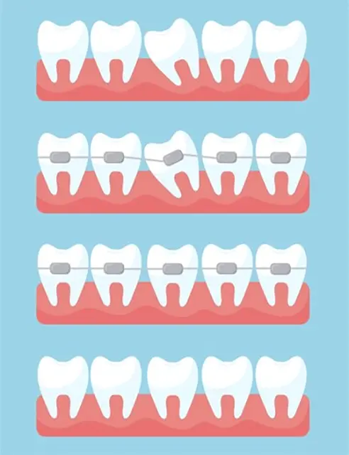 Ortodoncia - Alineación Dental