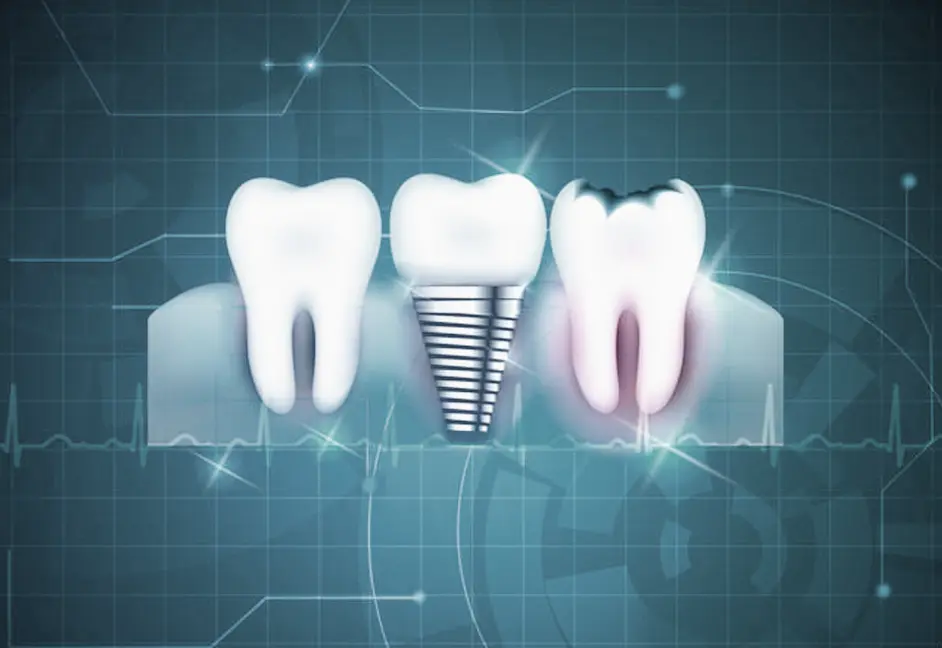 Implantes Dentales de Ultima Generación