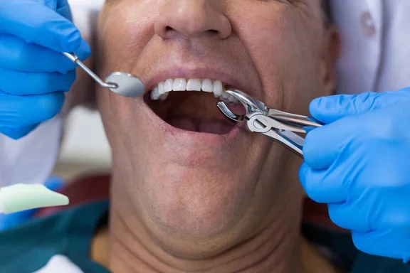 Extracción dental para adultos- clínica brelo