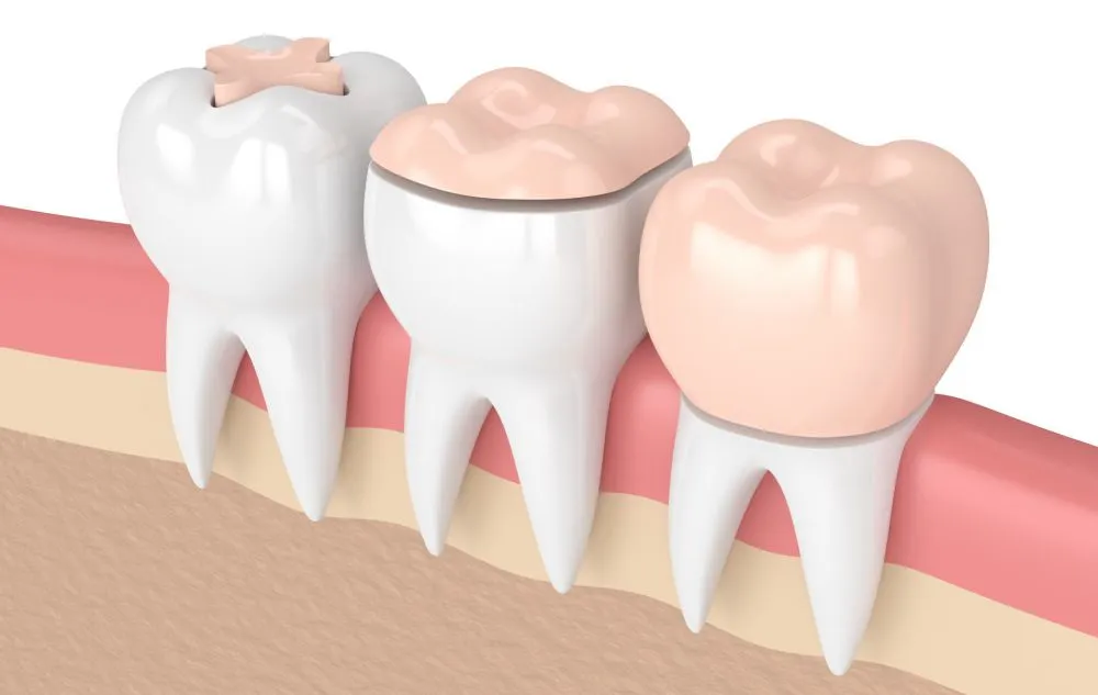 Tipos de protesis para implantes dentales