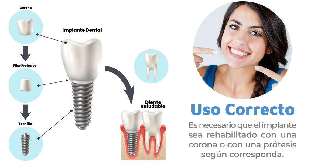 esquema de implantes dentales